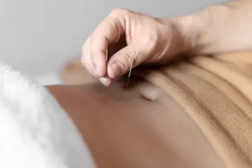 Slimming Acupuncture Treatment